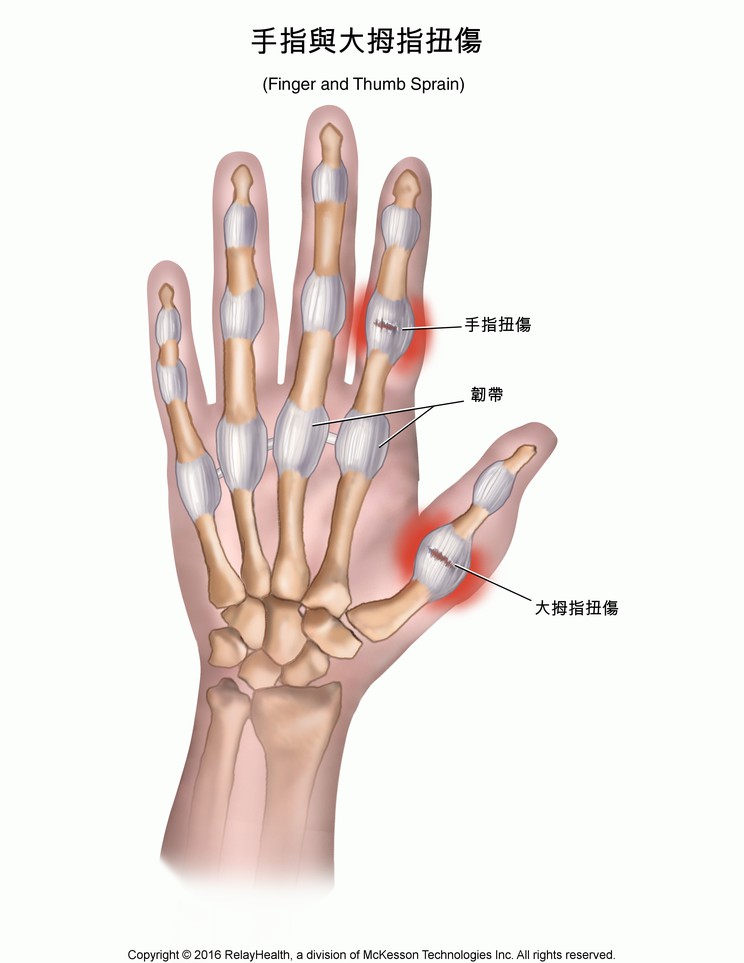 Finger and Thumb Sprain: Illustration