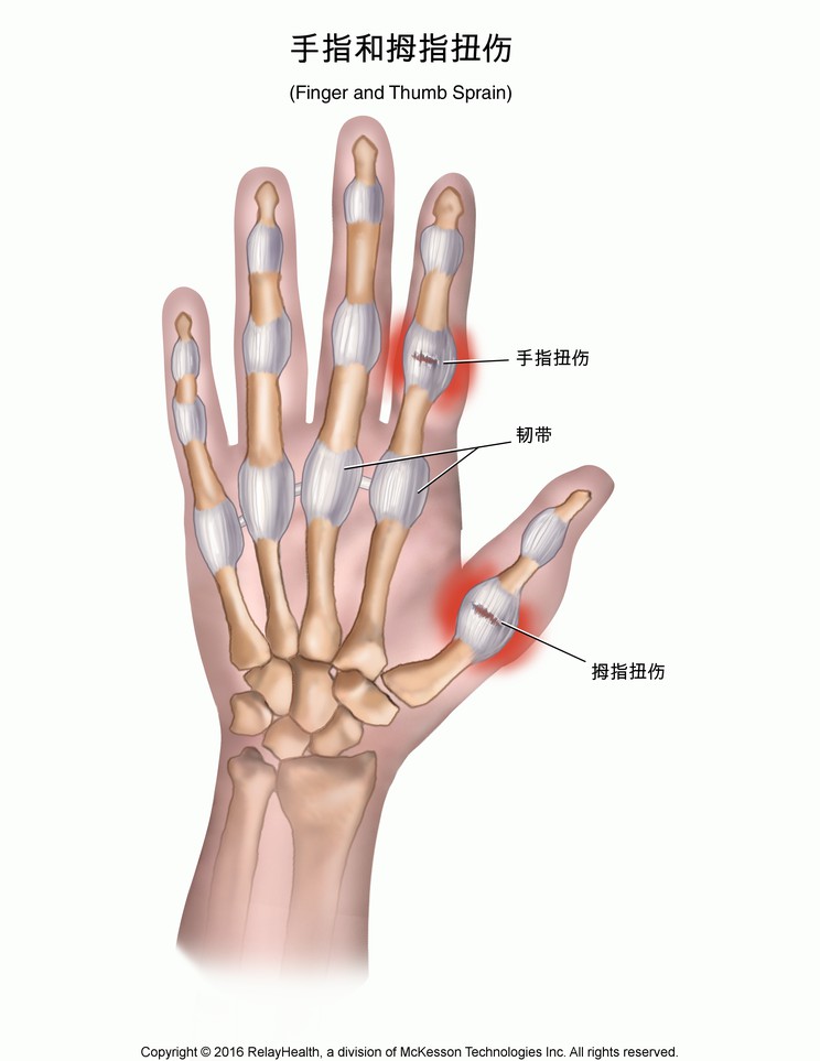 Finger and Thumb Sprain: Illustration