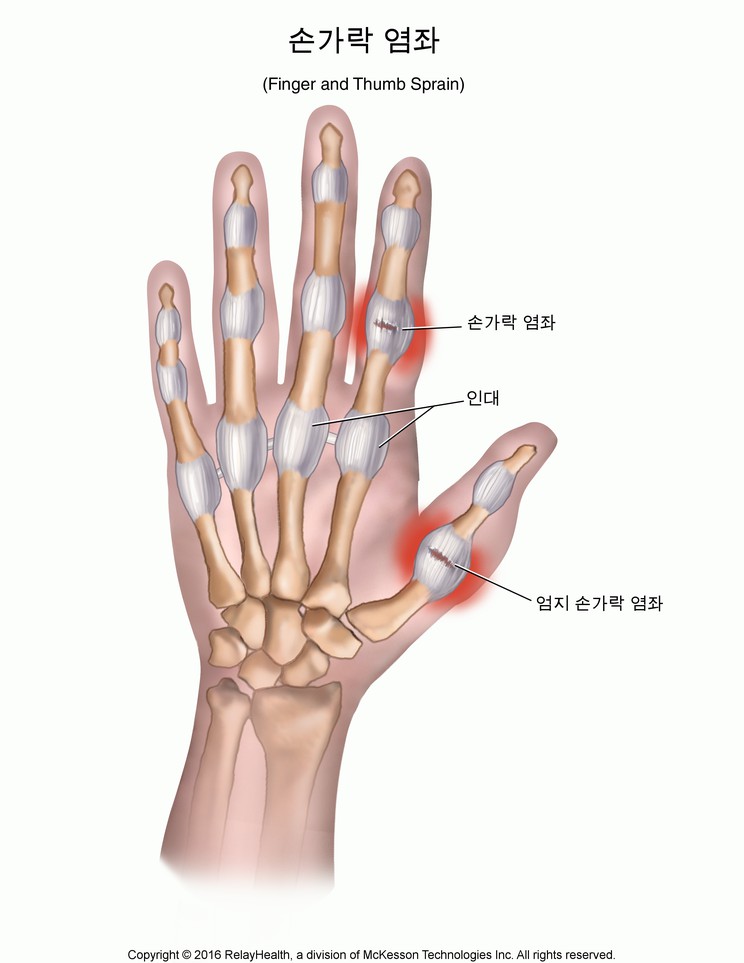 Finger and Thumb Sprain: Illustration