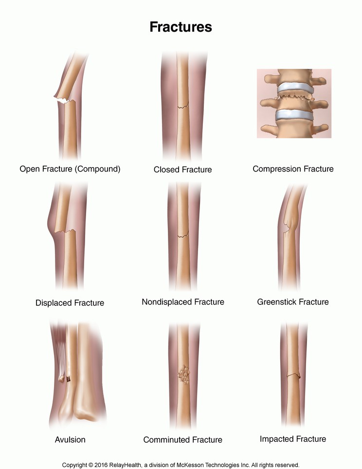 Fractures: Illustration