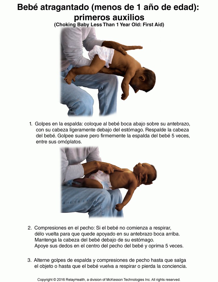 Choking Baby (Less Than 1 year Old): First Aid: Illustration