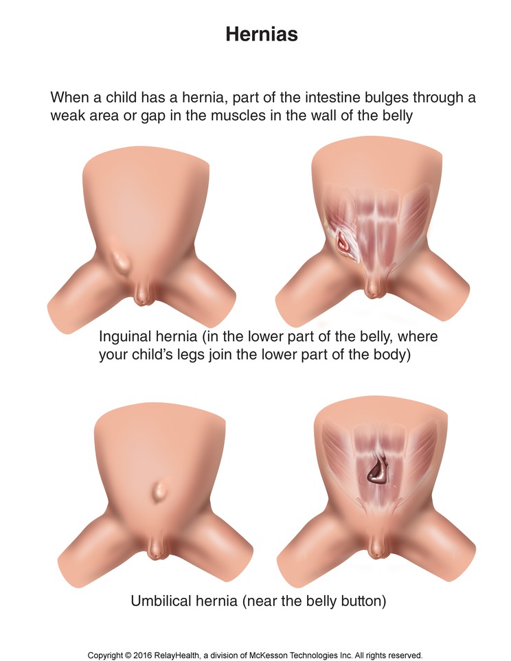 Hernia: Illustration