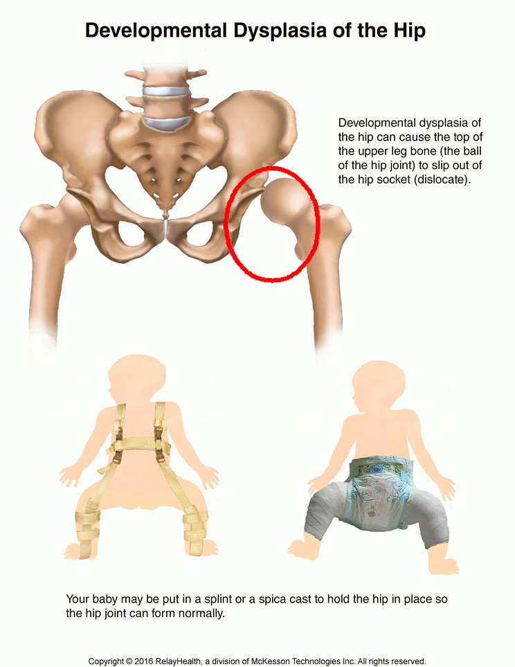 Developmental Hip Dysplasia: Illustration