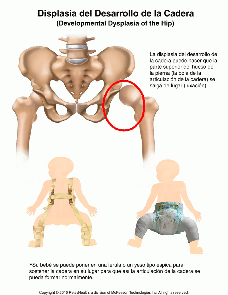 Developmental Hip Dysplasia: Illustration