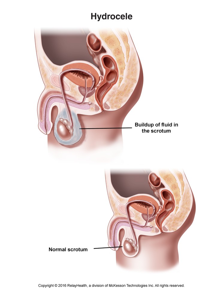 Hydrocele: Illustration