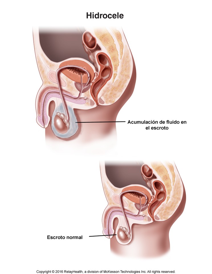 Hydrocele: Illustration