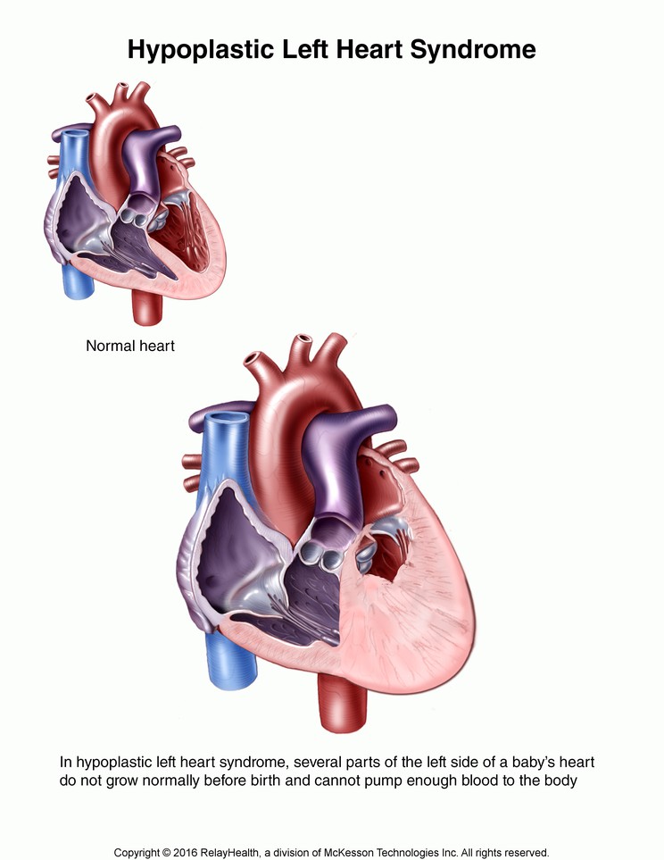 Hypoplastic Left Heart Syndrome: Illustration