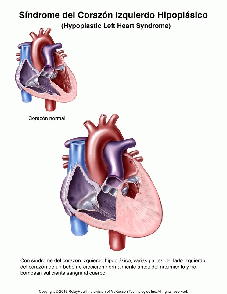 Hypoplastic Left Heart Syndrome: Illustration