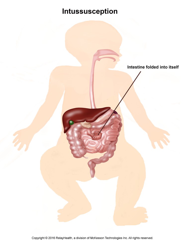 Intussusception: Illustration
