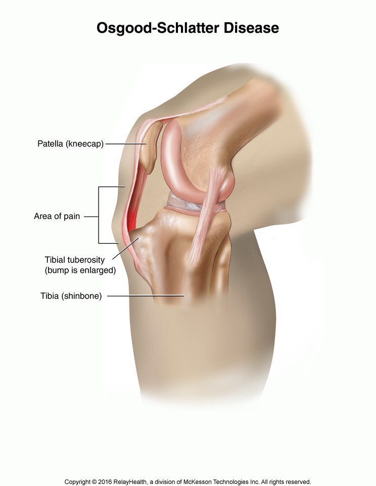 Osgood-Schlatter Disease: Illustration