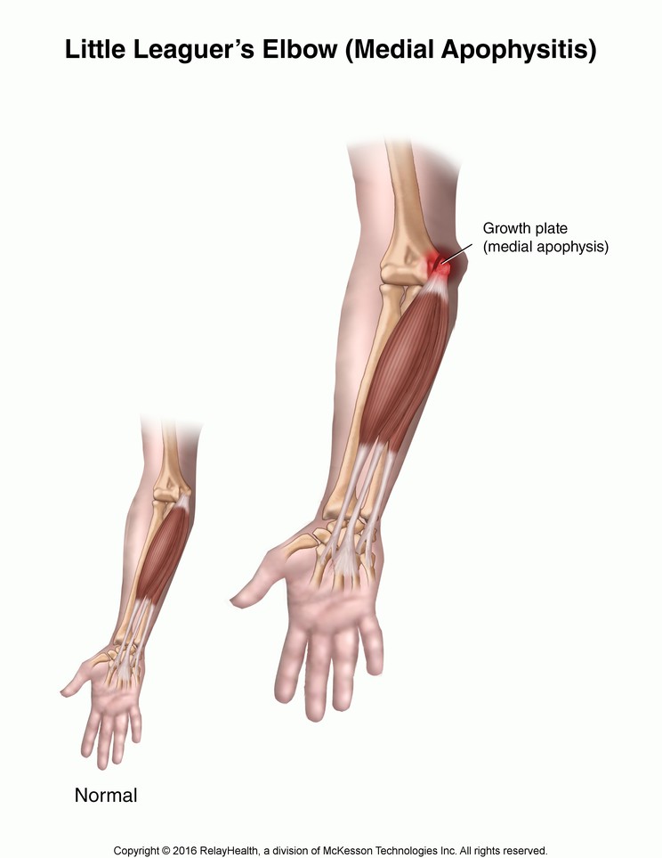 Little Leaguer's Elbow (Medial Apophysitis): Illustration