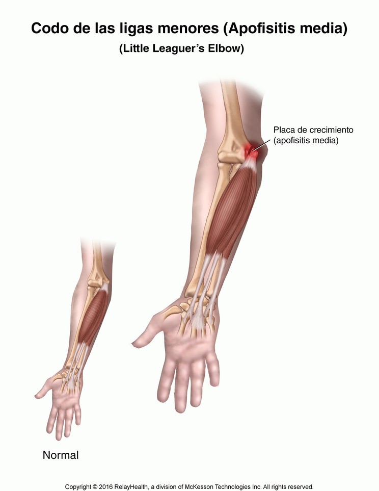 Little Leaguer's Elbow (Medial Apophysitis): Illustration
