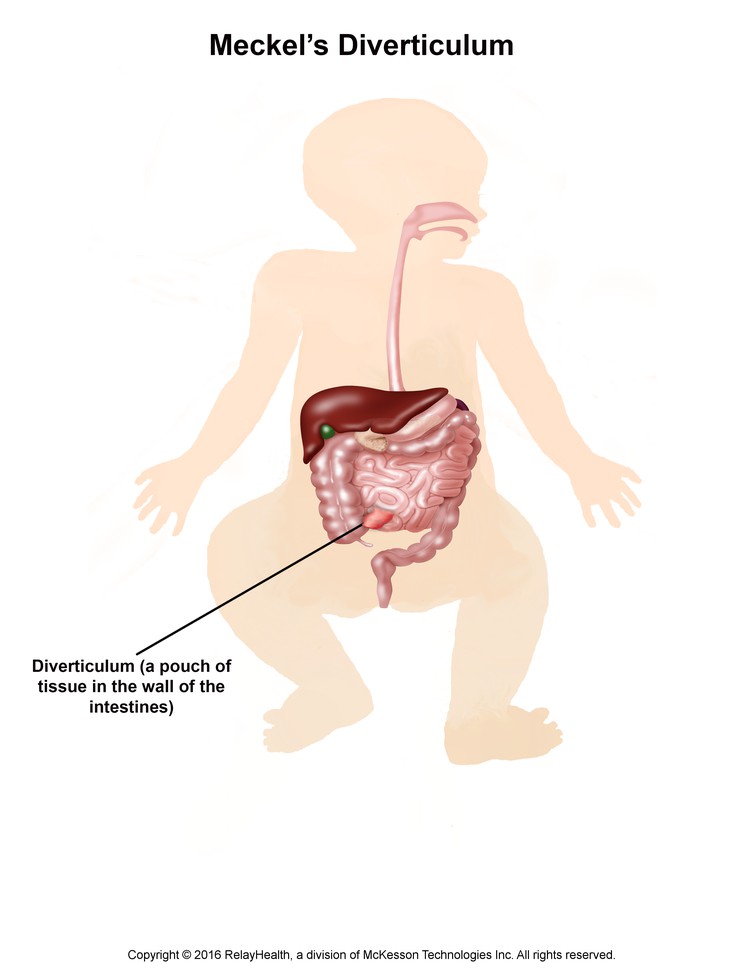 Meckel's Diverticulum: Illustration