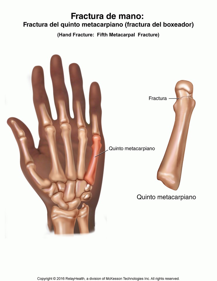 Hand Fracture: Fifth Metacarpal (Boxer's) Fracture, Illustration