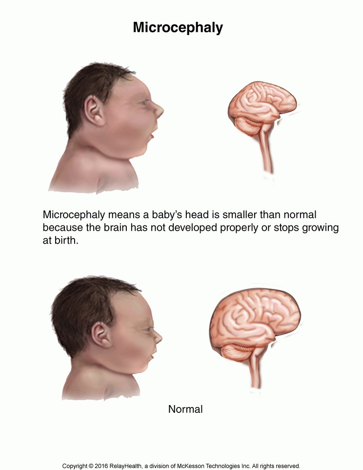 Microcephaly: Illustration