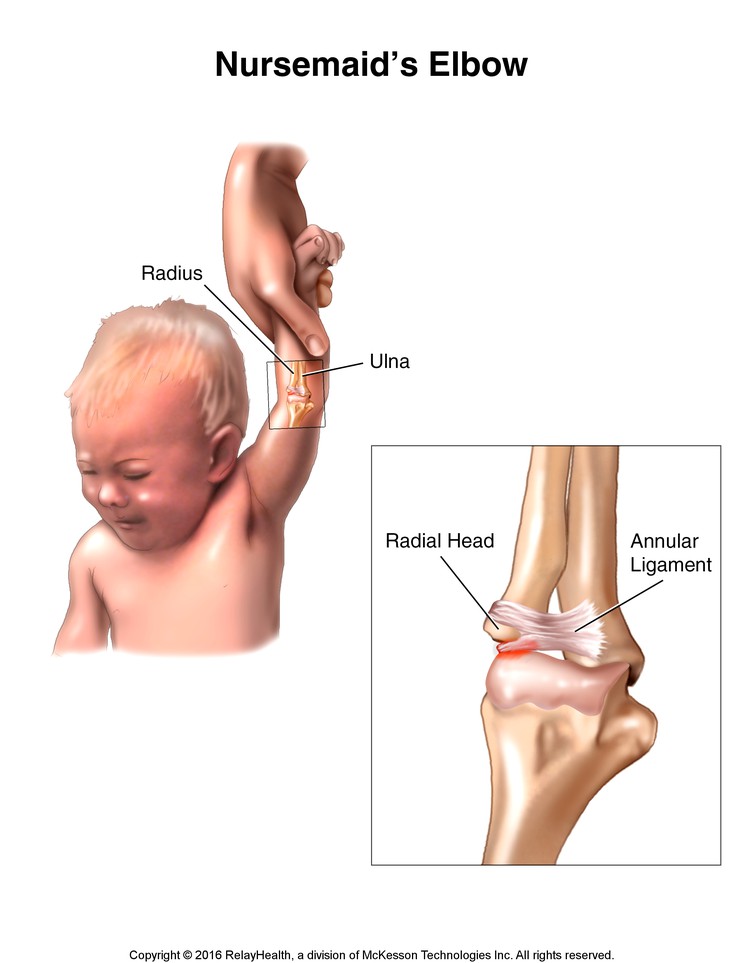 Nursemaid's Elbow: Illustration