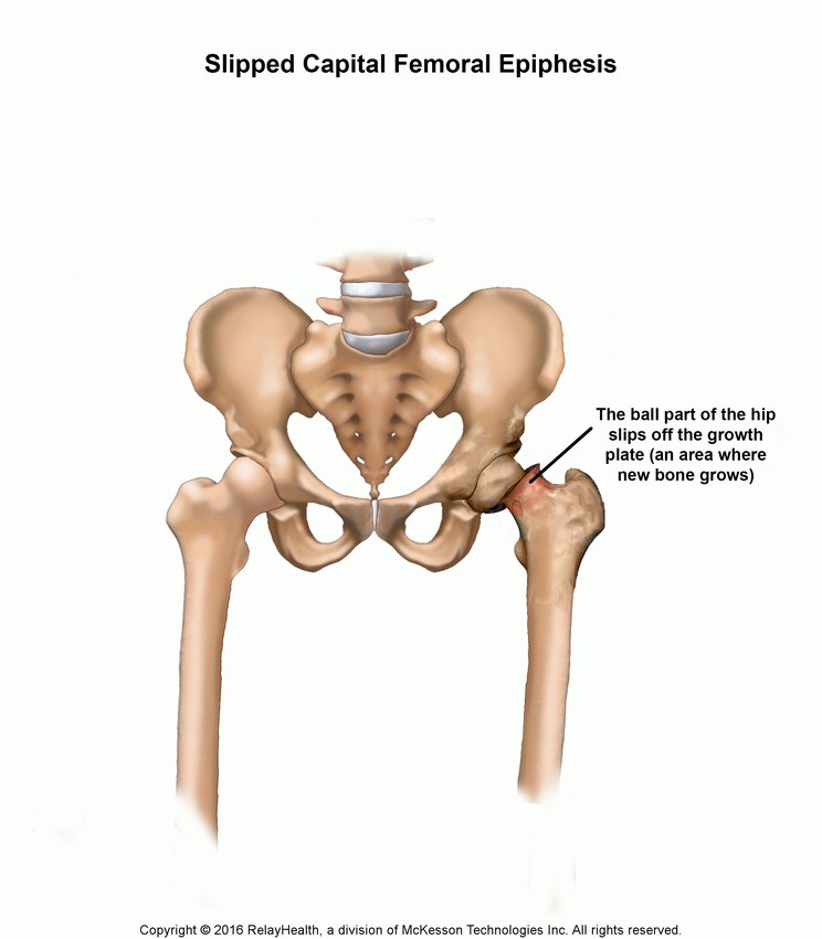 Slipped Capital Femoral Epiphysis: Illustration