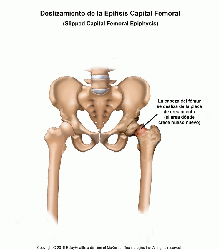 Slipped Capital Femoral Epiphysis: Illustration