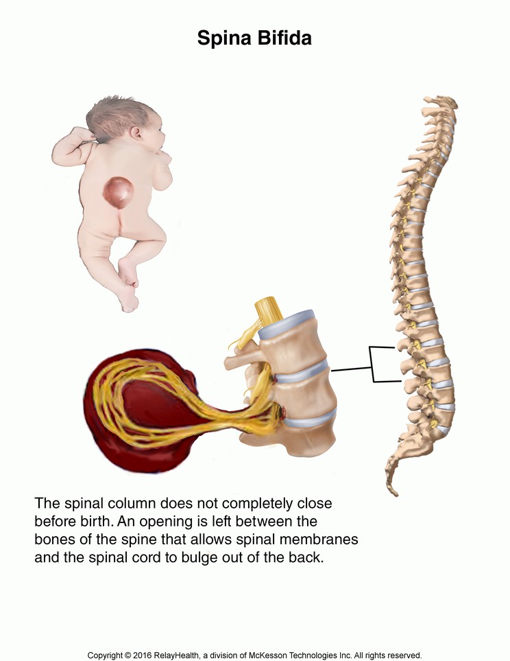 Spina Bifida: Illustration