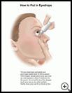Thumbnail image of: Eyedrops, How to Put in Eye: Illustration