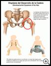 Thumbnail image of: Developmental Hip Dysplasia: Illustration