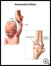 Thumbnail image of: Nursemaid's Elbow: Illustration