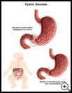 Thumbnail image of: Pyloric Stenosis: Illustration