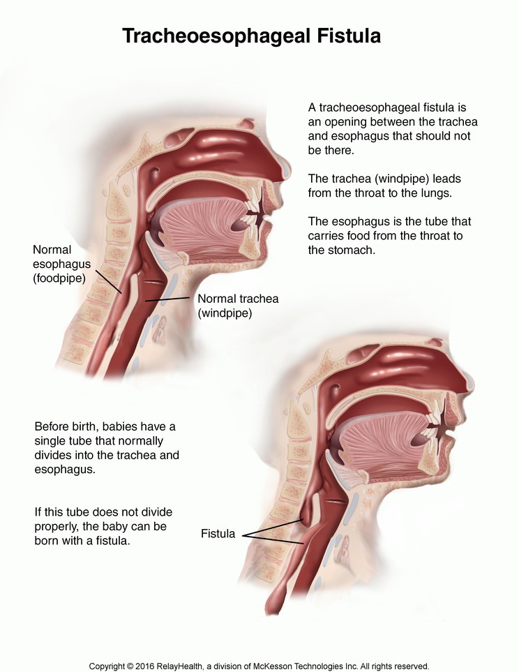 Tracheoesophageal Fistula in Children: Illustration