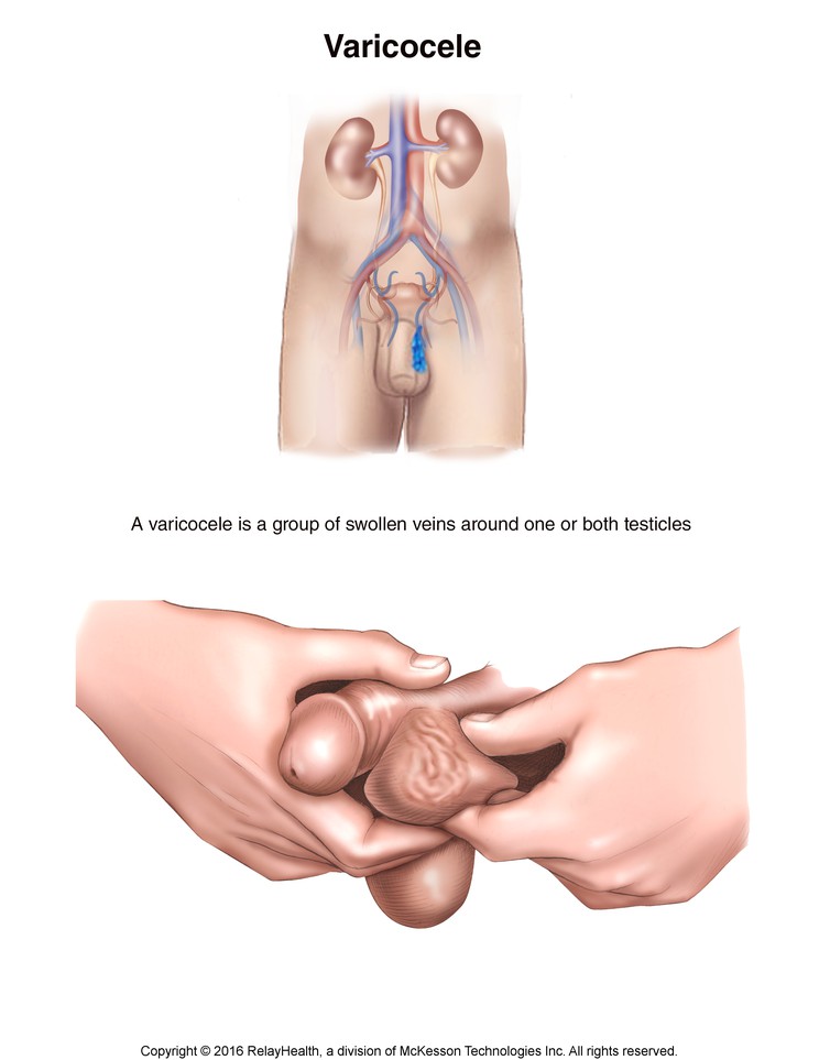 Varicocele (Swollen Veins Around Testicle): Illustration