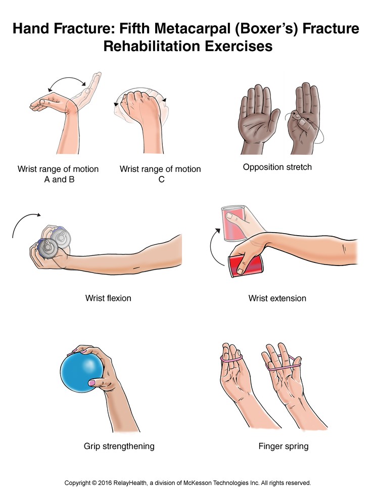 Hand Fracture: Fifth Metacarpal (Boxer's) Fracture Exercises, Illustration